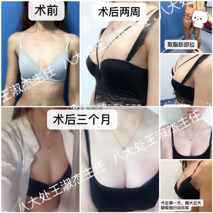 王淑杰自體脂肪豐胸案例