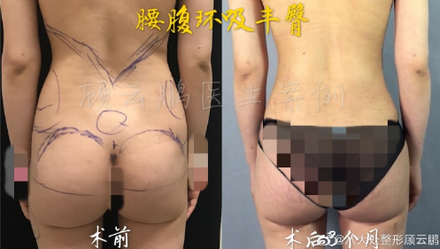 顧云鵬腰腹環吸案例