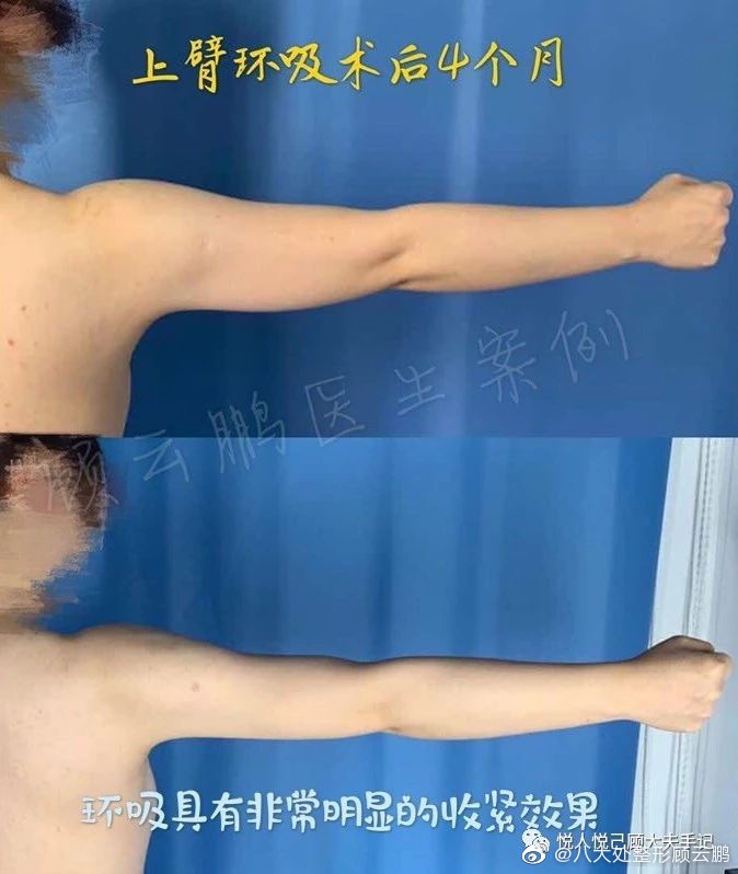 顧云鵬上臂環吸案例
