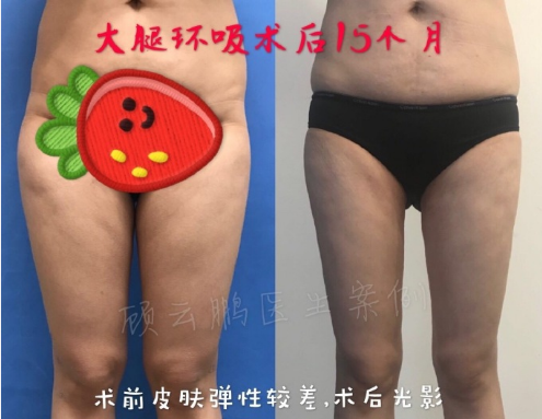 顧云鵬大腿環吸案例