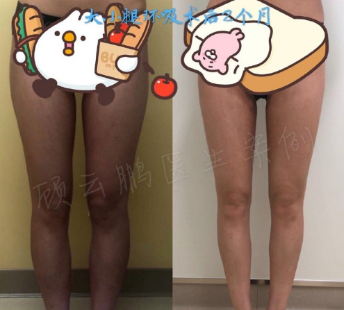 顧云鵬大腿吸脂案例