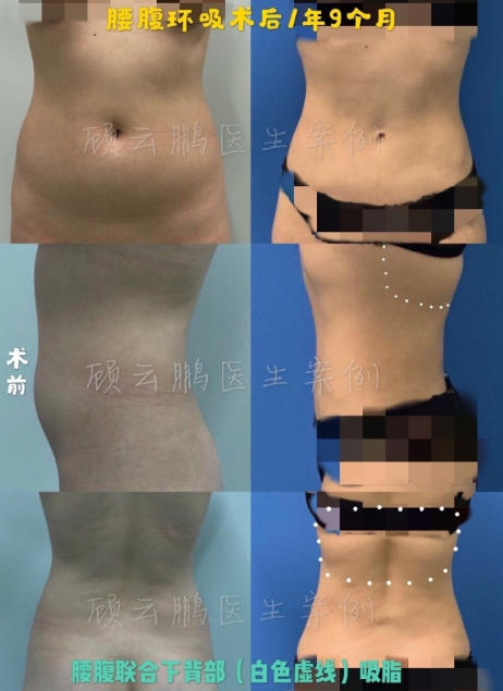 顧云鵬腰腹環吸案例