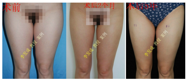 李發(fā)成大腿吸脂案例