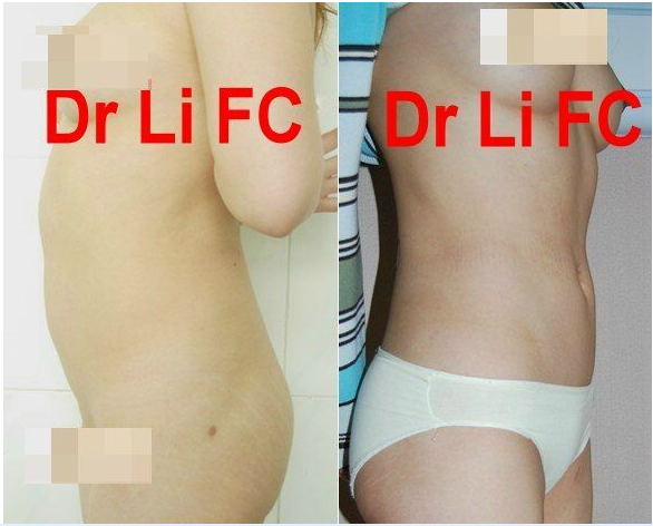 李發(fā)成腰腹吸脂案例