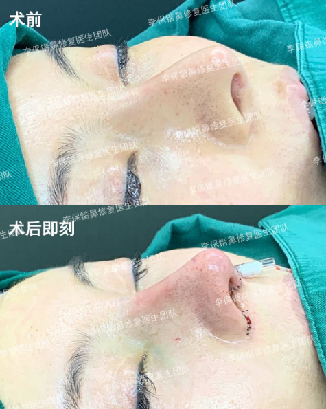 李保鍇鼻修復案例