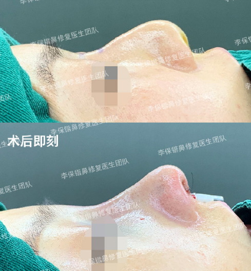李保鍇鼻修復案例
