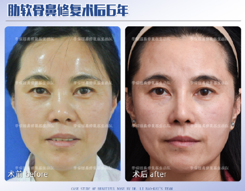 李保鍇鼻修復案例