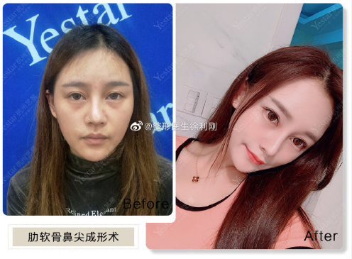 徐利剛鼻修復案例