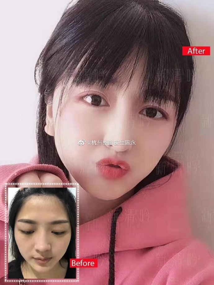 陳永鼻修復案例