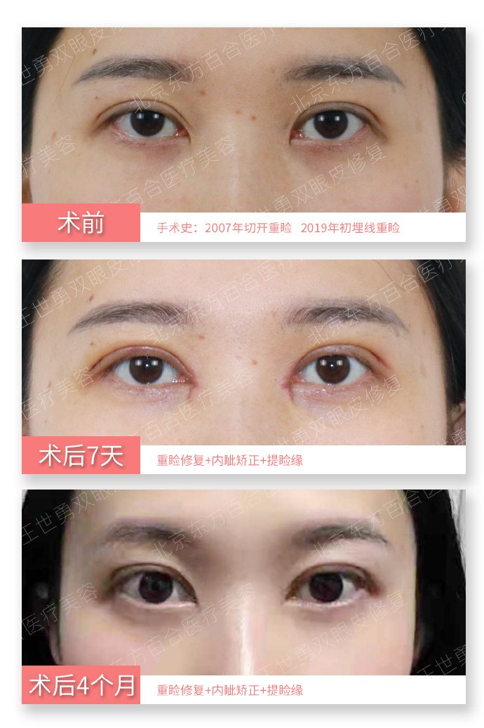 王世勇雙眼皮修復案例
