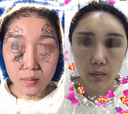 曹衛剛脂肪填充案例