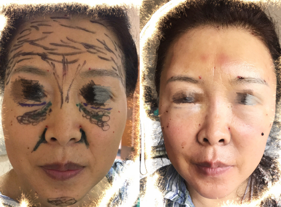 曹衛剛脂肪填充案例