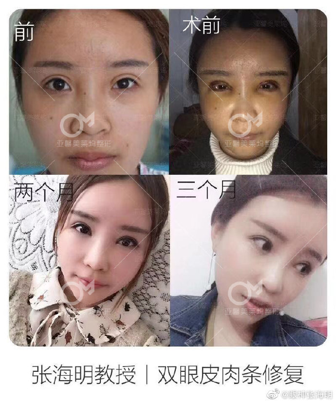 張海明雙眼皮修復案例
