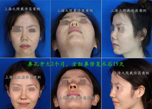 戴傳昌鼻修復(fù)案例