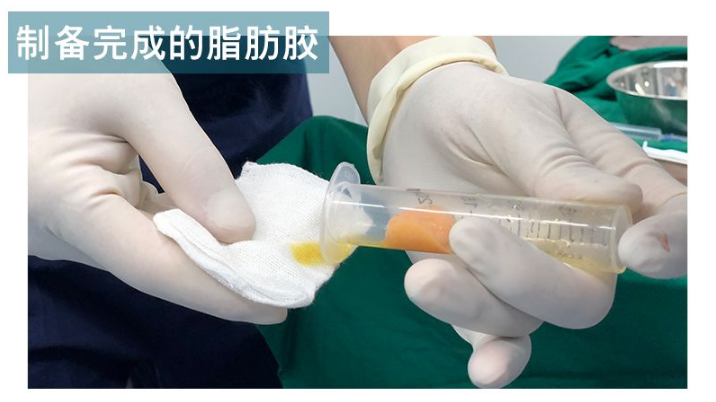 上海九院全臉脂肪填充多少錢
