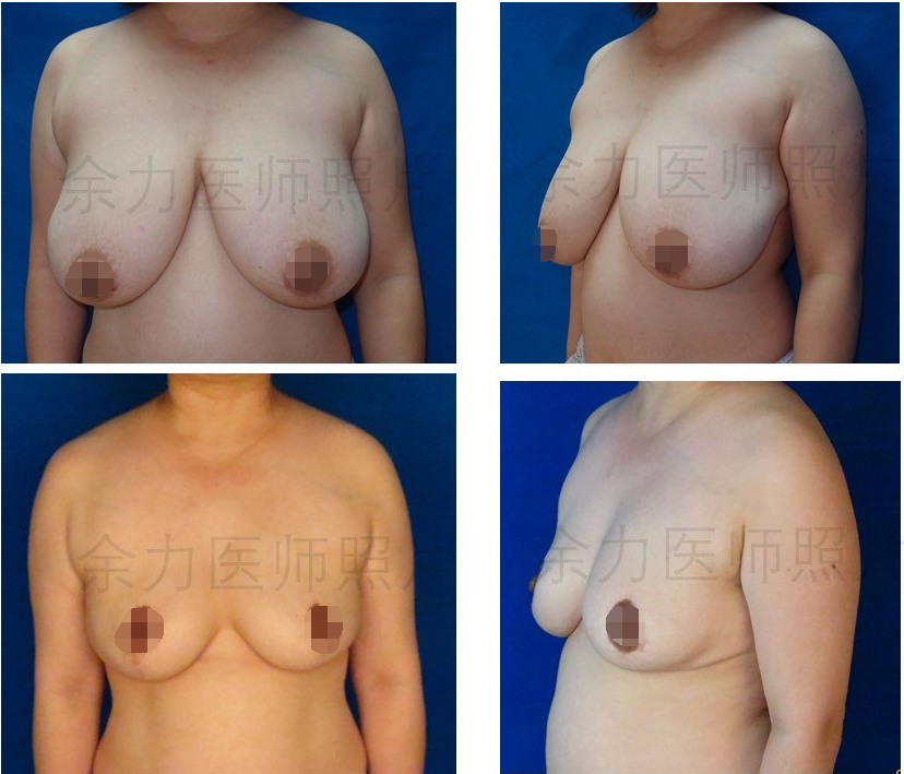 余力巨乳縮小案例