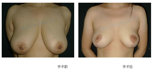 穆大力巨乳縮小案例
