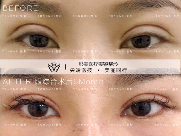 劉風卓雙眼皮修復案例