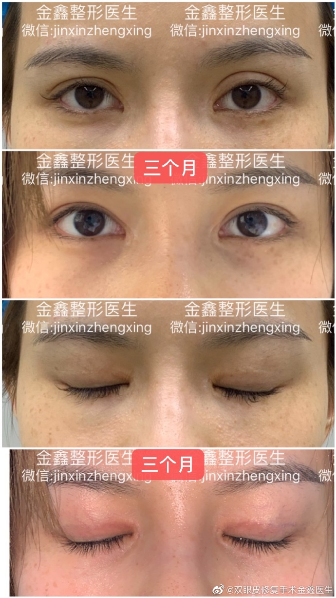 金鑫雙眼皮修復案例