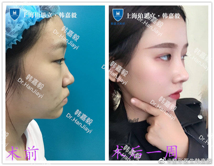 韓嘉毅隆鼻案例