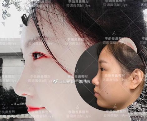 李勁良隆鼻案例