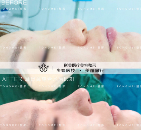 李長賦隆鼻案例
