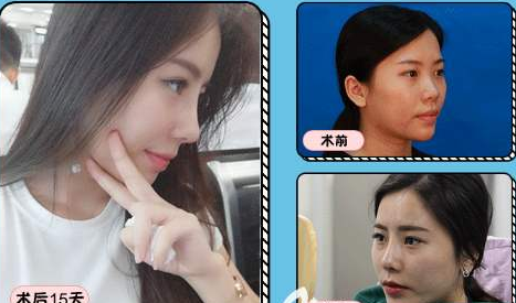 北京哪個(gè)醫(yī)生做鼻子最好？