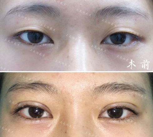 王太玲雙眼皮案例
