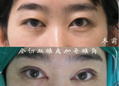 王太玲雙眼皮案例