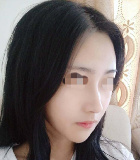 向宏偉鼻修復案例
