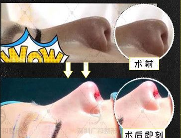 易普鋒鼻修復案例