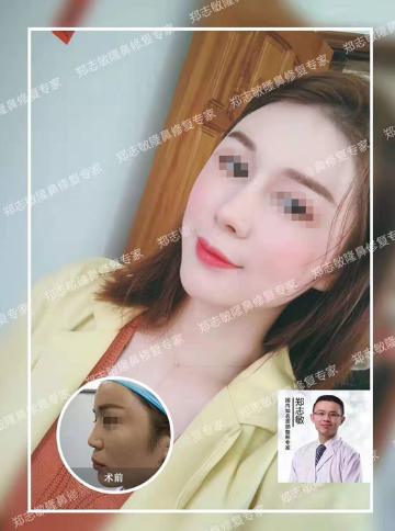 鄭志敏鼻修復案例