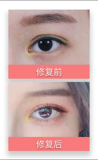王世勇雙眼皮修復