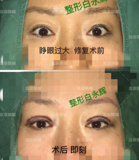 白永輝眼修復案例