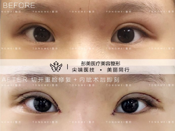 劉風卓眼修復案例