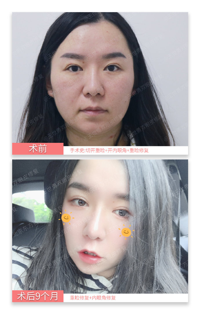 王世勇雙眼皮修復案例