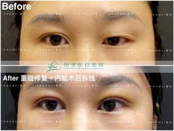 北京劉風卓、白永輝和王世勇誰修復雙眼皮最好呢