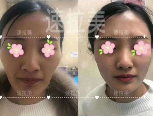 孫瑋駿面部提升案例