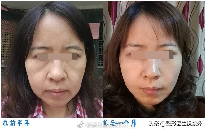 祝東升面部提升案例