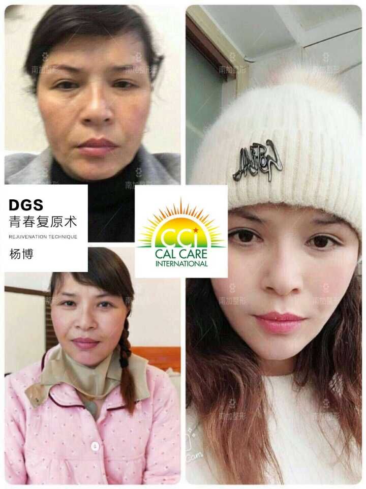 楊博面部提升案例