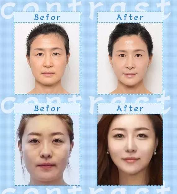 北京哪個醫生面部提升修復手術做的好