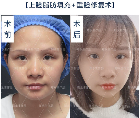 鄭永生雙眼皮修復案例