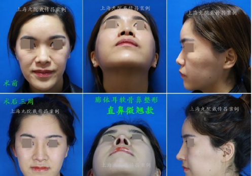 戴傳昌鼻子案例