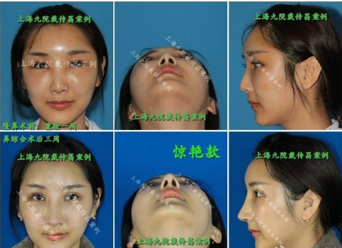 戴傳昌鼻子案例
