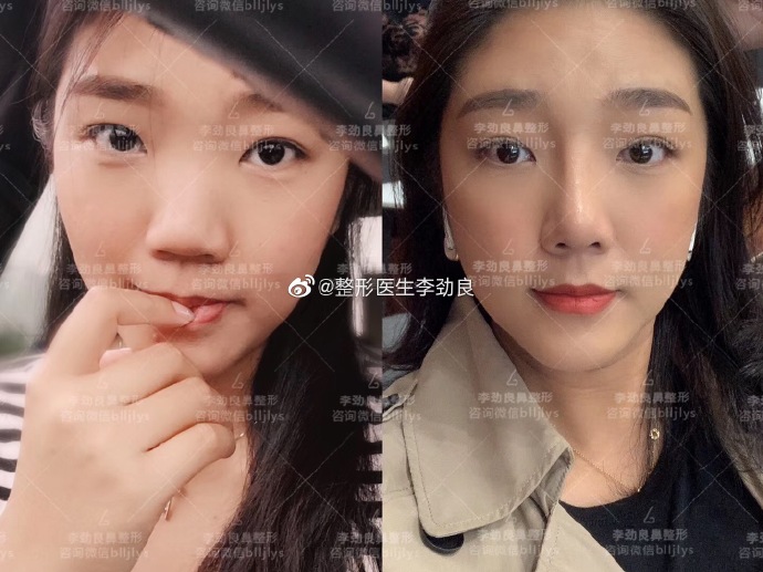 李勁良鼻綜合案例