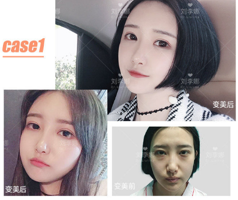 劉李娜面部填充案例