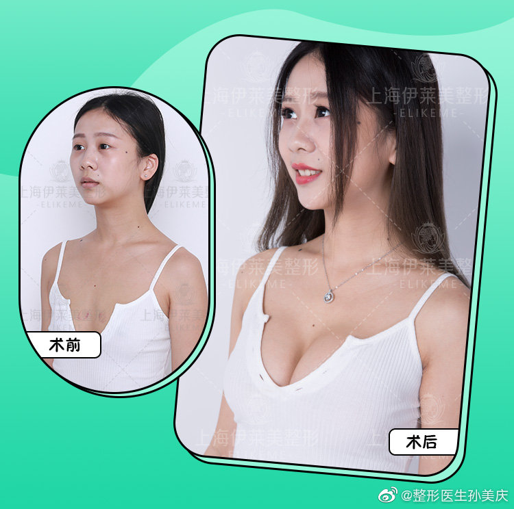 孫美慶脂肪豐胸案例