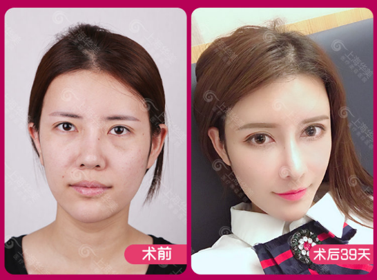 上海華美面部填充案例