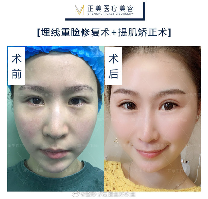 鄭永生雙眼皮修復案例