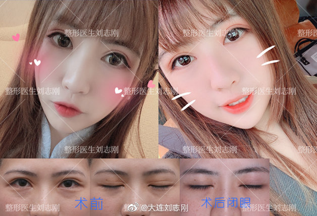 劉志剛眼修復案例